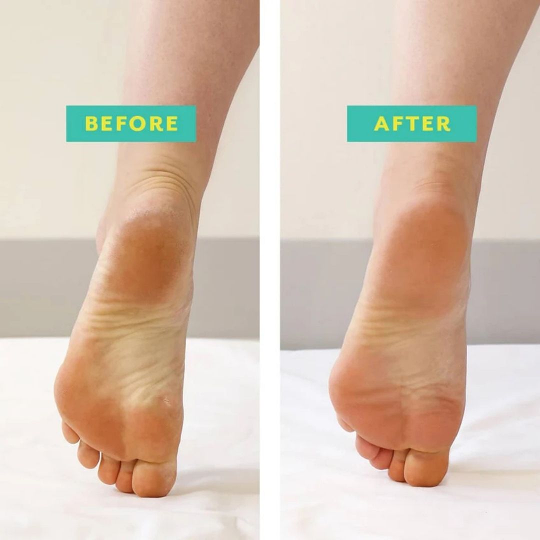 POSHPEEL Pedi Cure